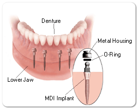 mini-dental-implants